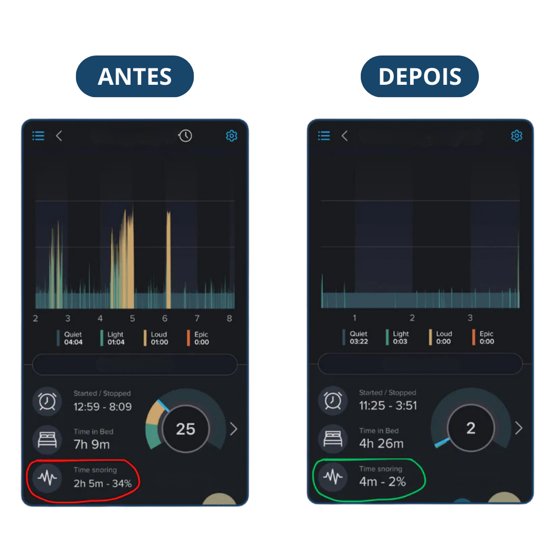Protetor Bucal Anti-Ronco