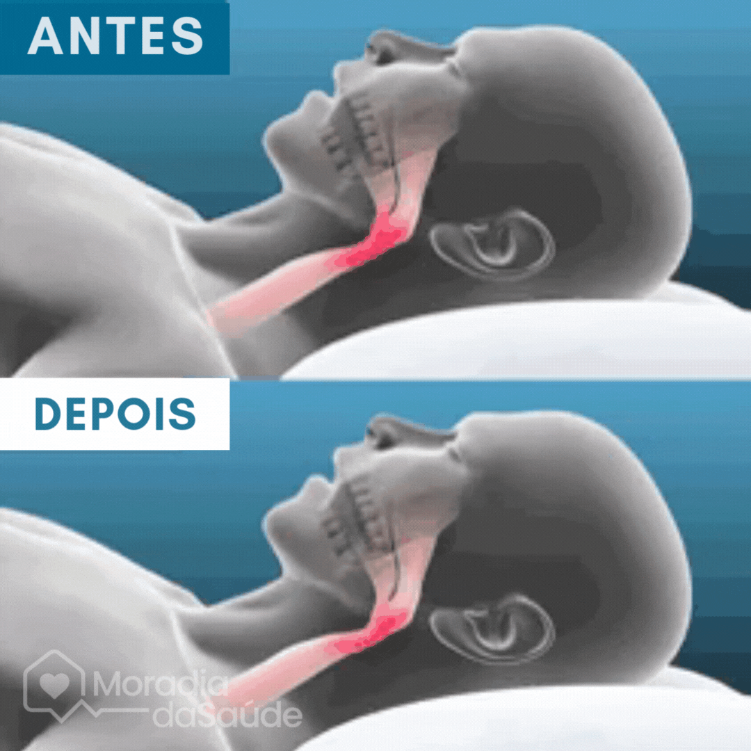 Protetor Bucal Anti-Ronco